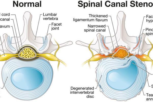 What is the Newest Treatment for Spinal Stenosis?