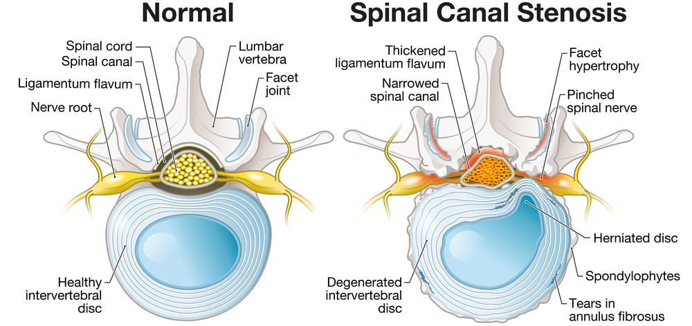 What is the Newest Treatment for Spinal Stenosis?
